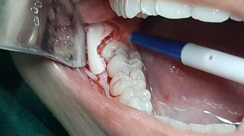 Imersão em Endodontia do Acesso à obturação