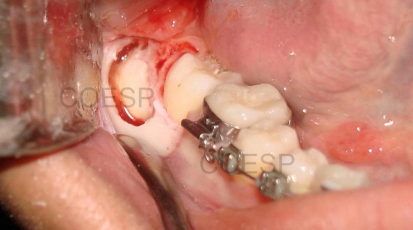 Imersão em Endodontia do Acesso à obturação